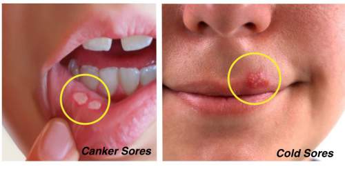 Find-Out-The-Difference-Between-Cold-Sores-and-Canker-Sores.jpg
